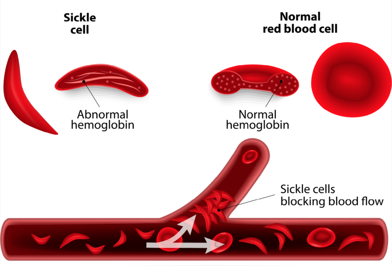 Sickle cell disease is an inherited blood disorder in which damaged hemoglobin can't deliver oxygen to cells in the body. It afflicts millions of people worldwide.